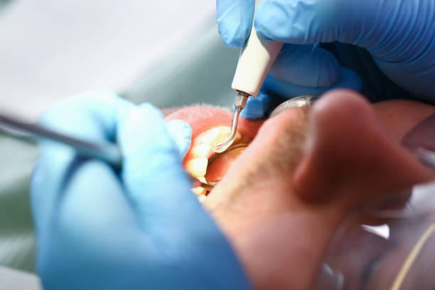 Best Emergency Dental Care for Broken or Chipped Teeth in Urbandale, IA